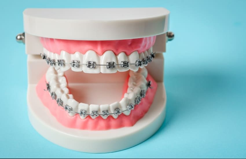 Dental braces fitting for children and adults in Sharjah