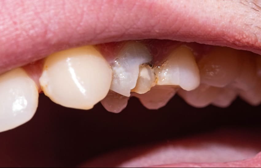 Fixing broken or chipped teeth in dental emergency