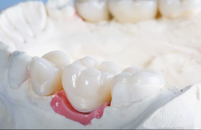 Dental crown and bridgework services in Sharjah clinic