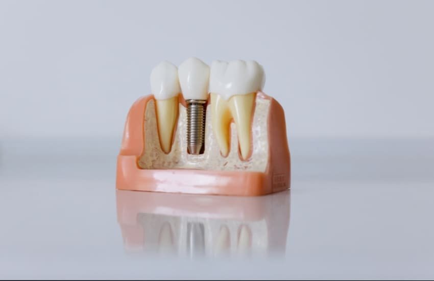 Permanent dental implant service in Sharjah