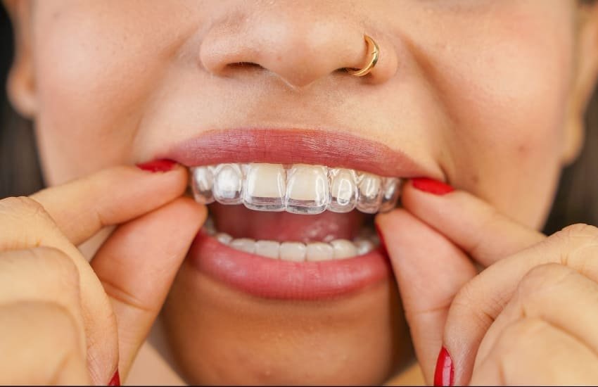 Transparent aligners for teeth straightening at Shifa Al Jazeera
