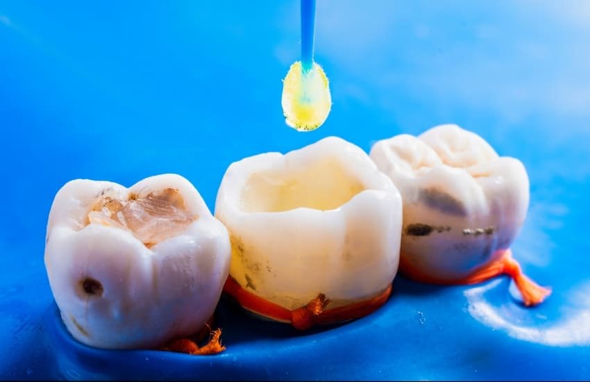 Tooth filling procedure by general dentist in Sharjah clinic