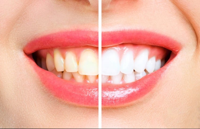 Teeth whitening treatment for a brighter smile