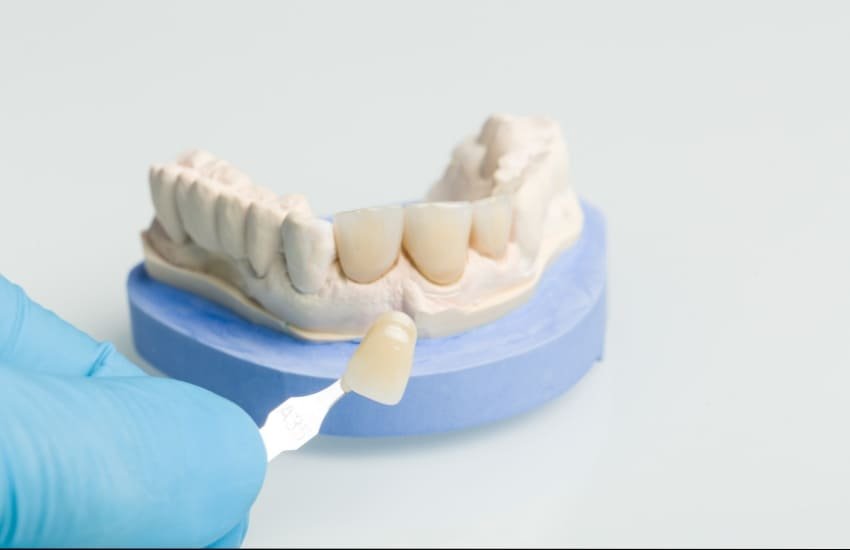 Porcelain dental veneers application